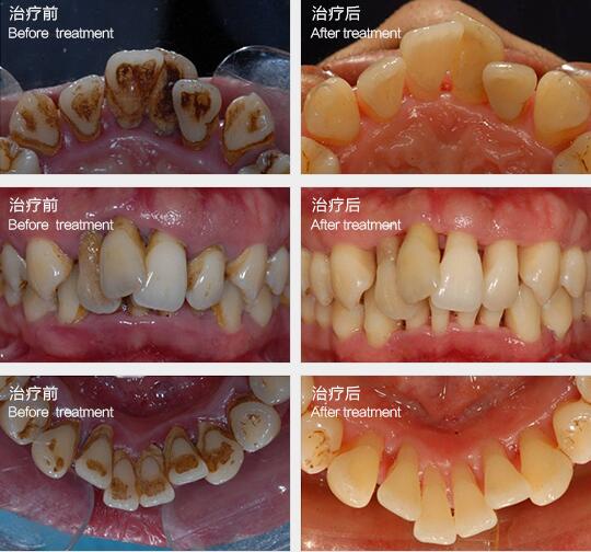 牙周病治疗前后对比图