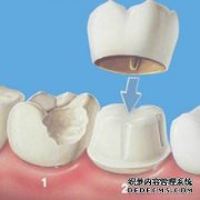 紫金县种植牙以后吃饭会不会有影响 