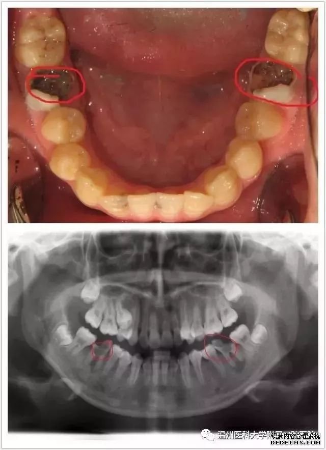 呼市【口腔百科】六龄牙重度龋坏,甚至缺失怎